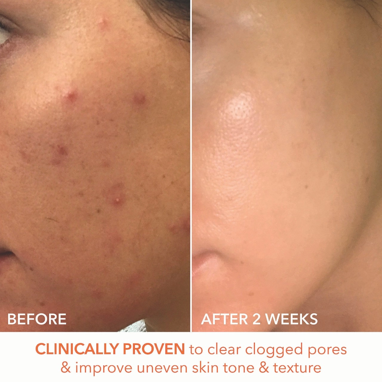 Dr. Dennis Gross Skincare Mini Alpha Beta® Extra Strength Daily Peel Pads - Size: 5 Treatments - Image 2