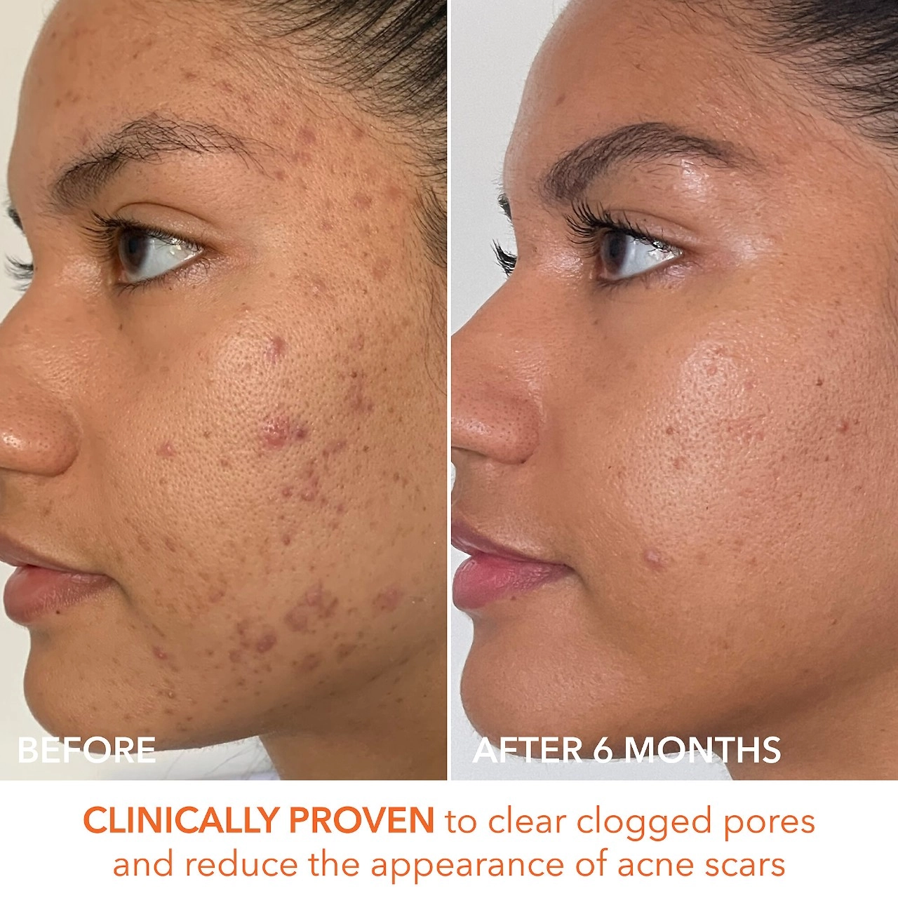 Dr. Dennis Gross Skincare Mini Alpha Beta® Extra Strength Daily Peel Pads - Size: 5 Treatments - Image 8