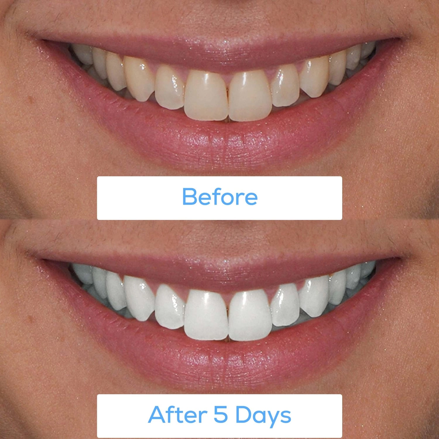 GLO Science GLO Brilliant® White Smile - At Home Teeth Whitening Device (White, Refill Available) - Image 4