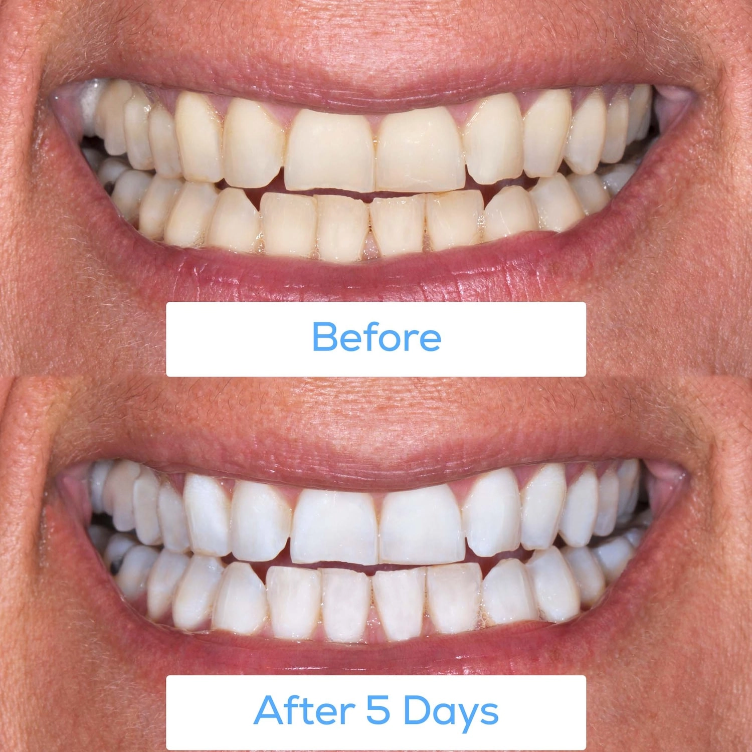 GLO Science GLO Brilliant® White Smile - At Home Teeth Whitening Device (White, Refill Available) - Image 3