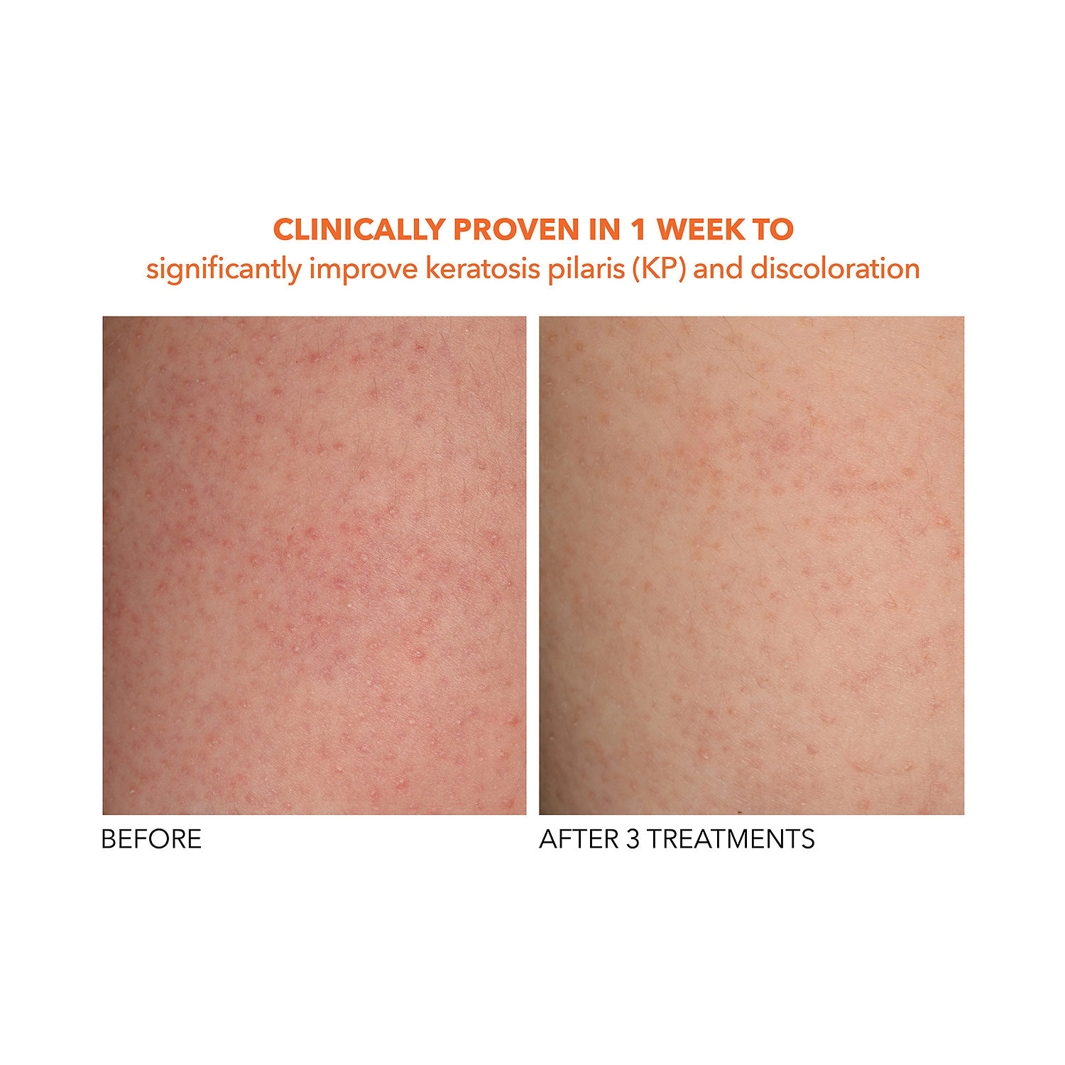 Dr. Dennis Gross Skincare Mini Alpha Beta® Exfoliating Body Treatment Peel - 2 Textured Towels - Image 2