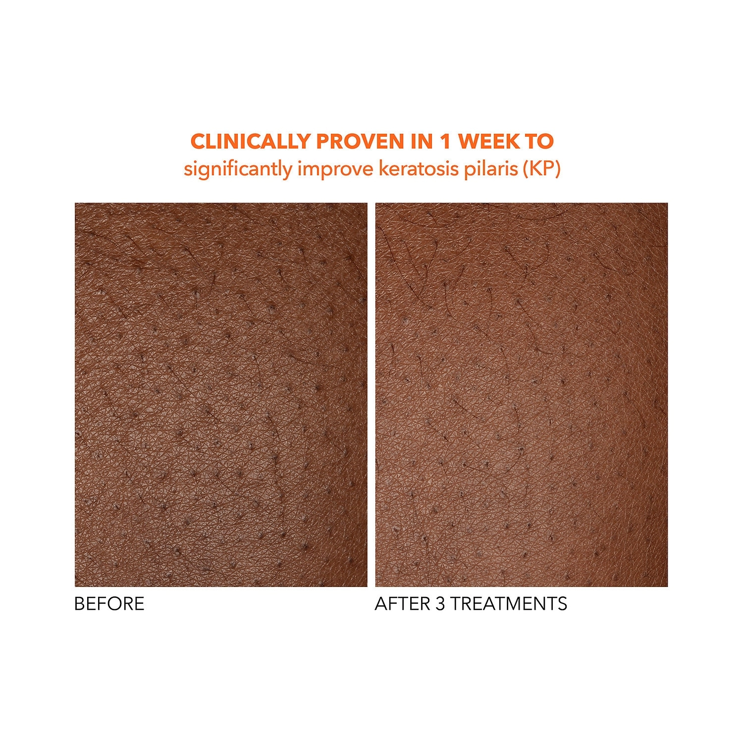 Dr. Dennis Gross Skincare Alpha Beta® Exfoliating Body Treatment Peel - Size: 2 Textured Towels - Image 3