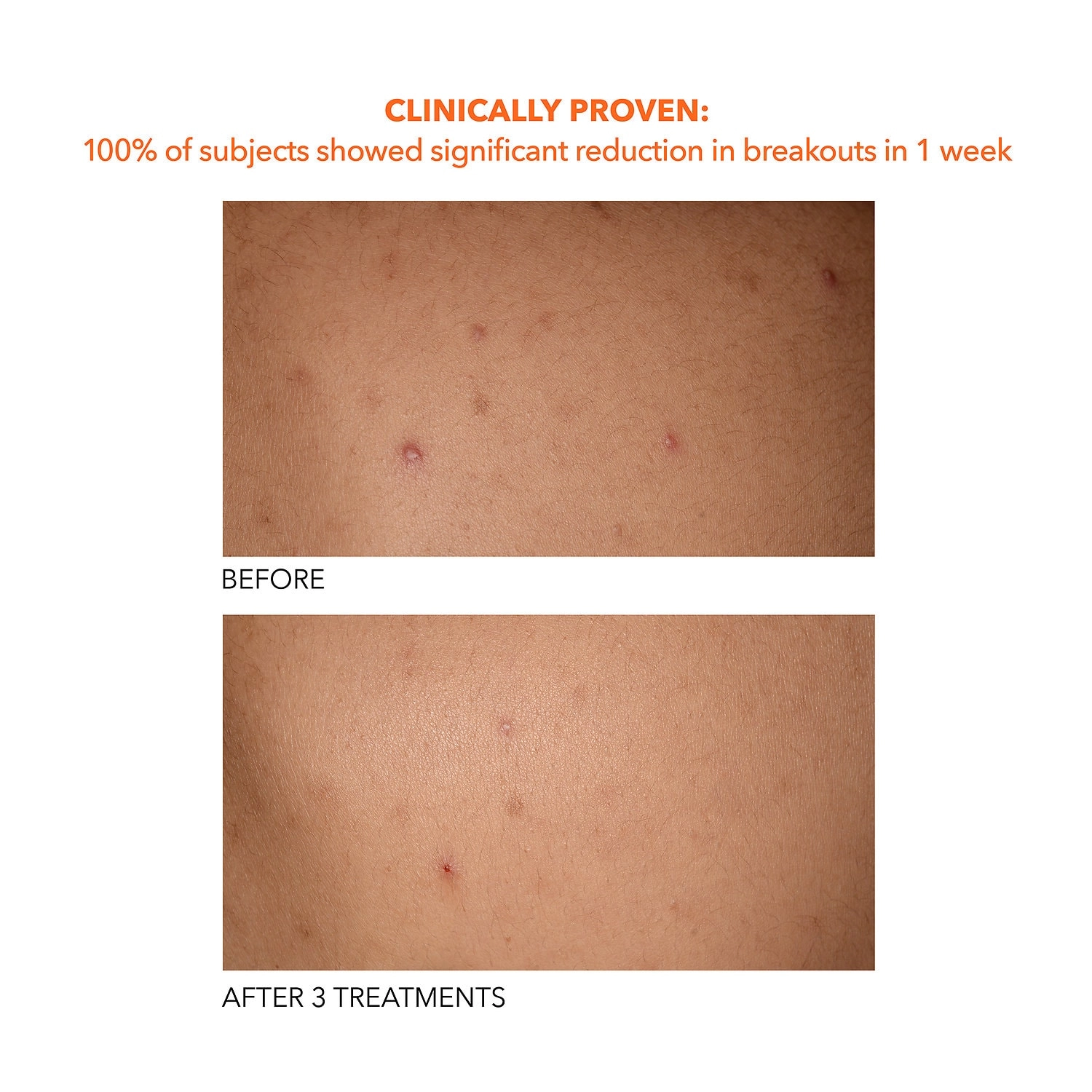 Dr. Dennis Gross Skincare Mini Alpha Beta® Exfoliating Body Treatment Peel - 2 Textured Towels - Image 17