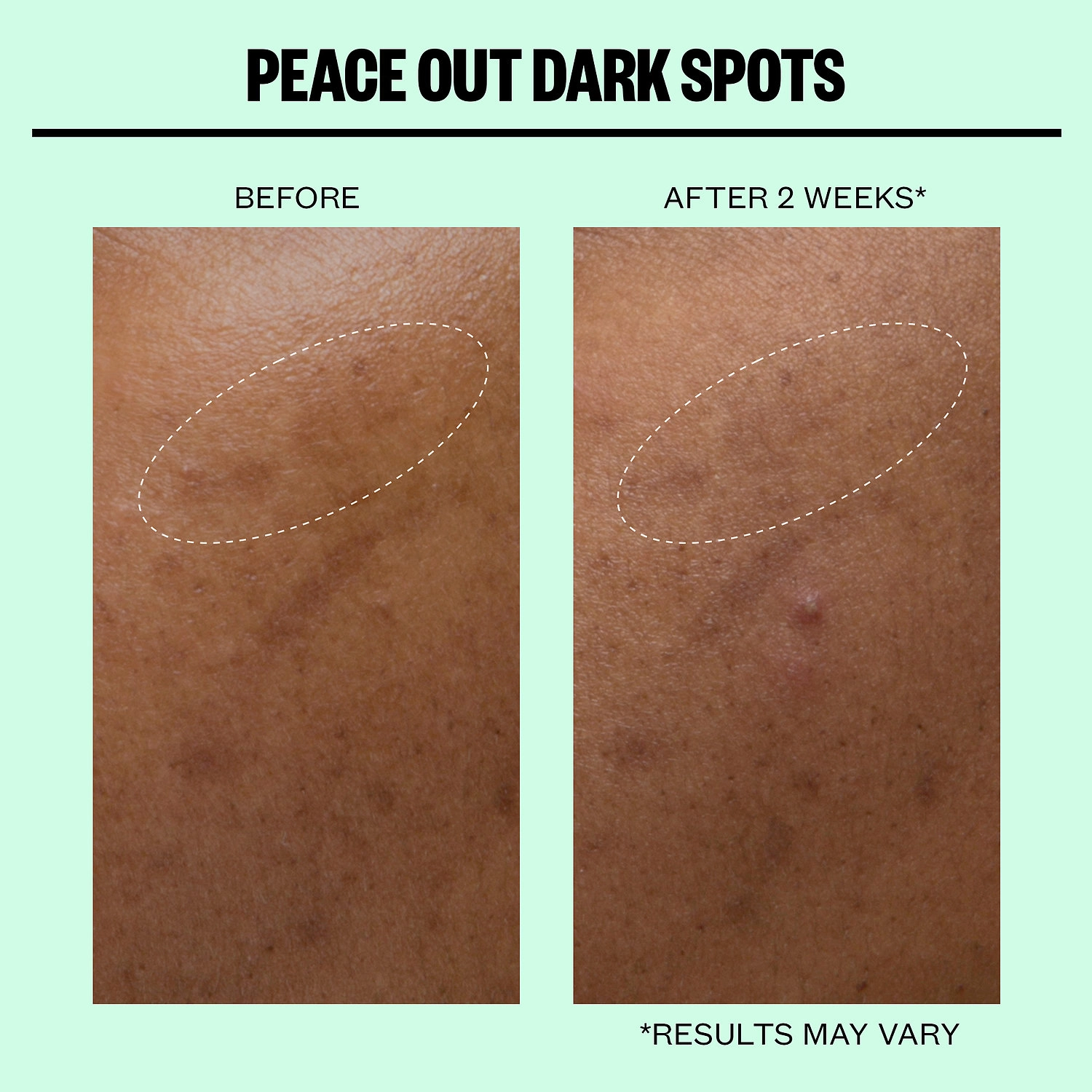 Peace Out Microneedling Dark Spot Brightening Dots with Hyaluronic Acid - Image 7