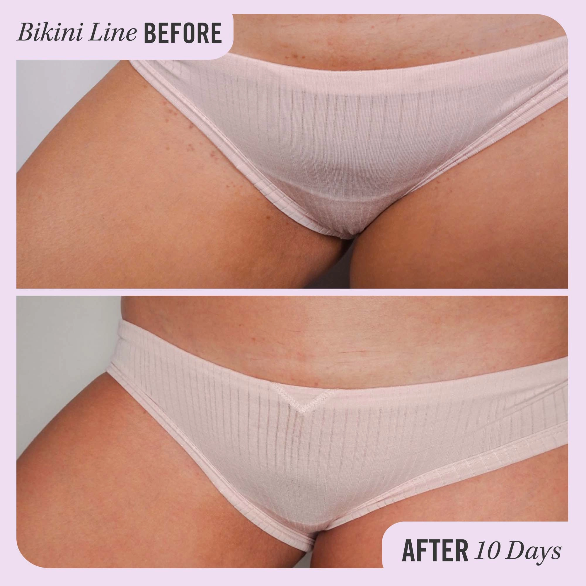 First Aid Beauty Ingrown Hair Pads with BHA & AHA, Size: 28 Pads, Vegan, Clean - Image 2