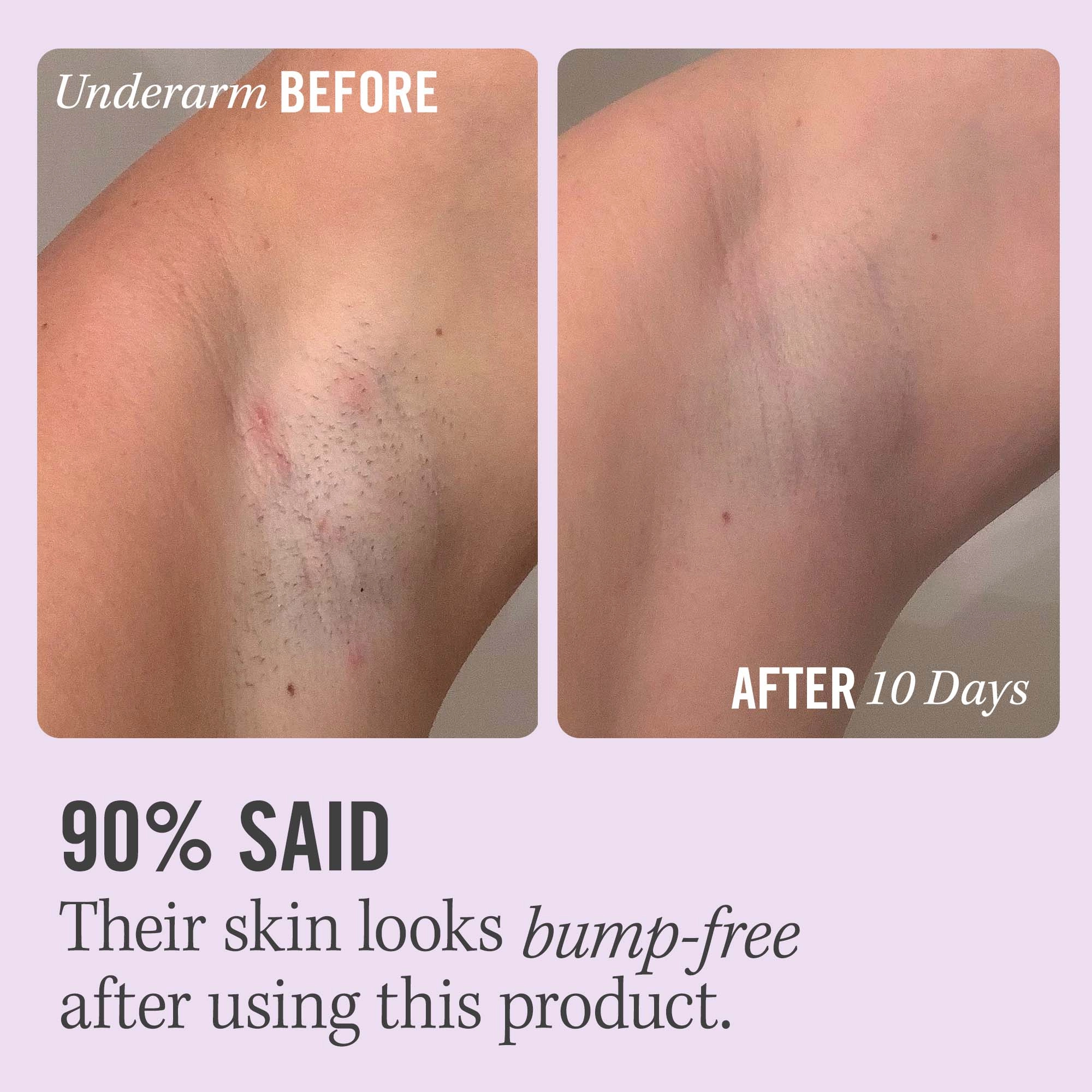 First Aid Beauty Ingrown Hair Pads with BHA & AHA, Size: 28 Pads, Vegan, Clean - Image 3