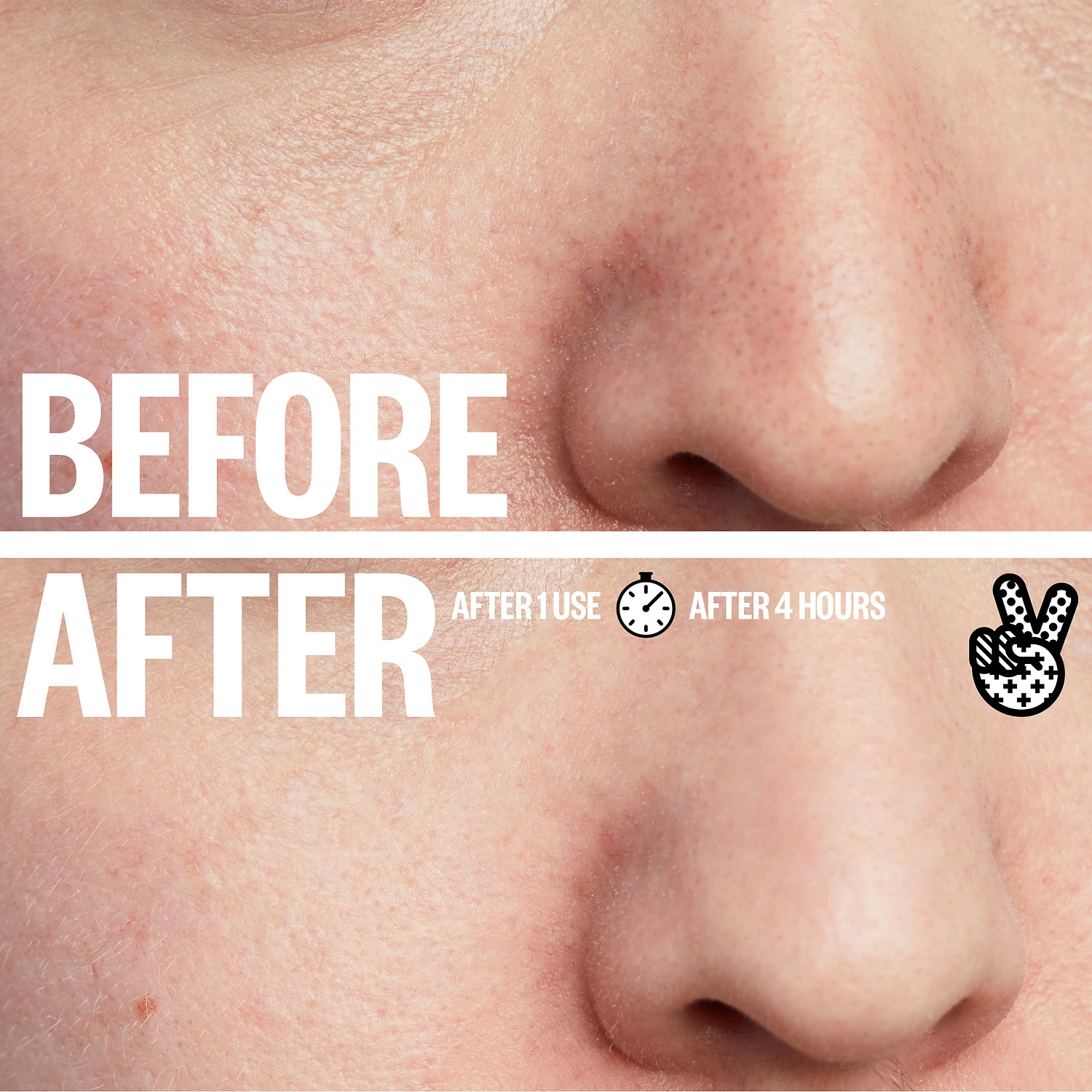 Peace Out Oil-Absorbing Pore Treatment Strips for Oily Skin - Image 5