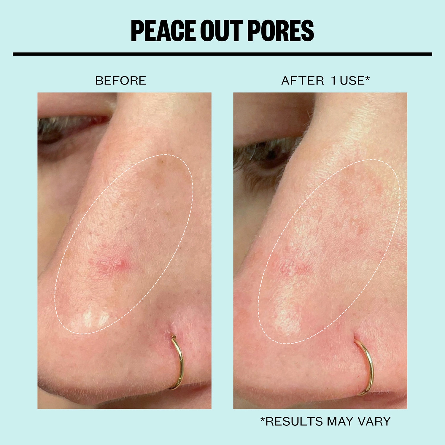 Peace Out Oil-Absorbing Pore Treatment Strips for Oily Skin - Image 4