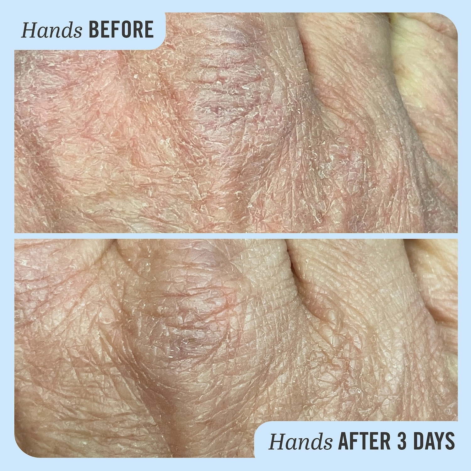 First Aid Beauty Ultra Repair® Cream Intense Hydration 6 oz/ 170 g - Image 7