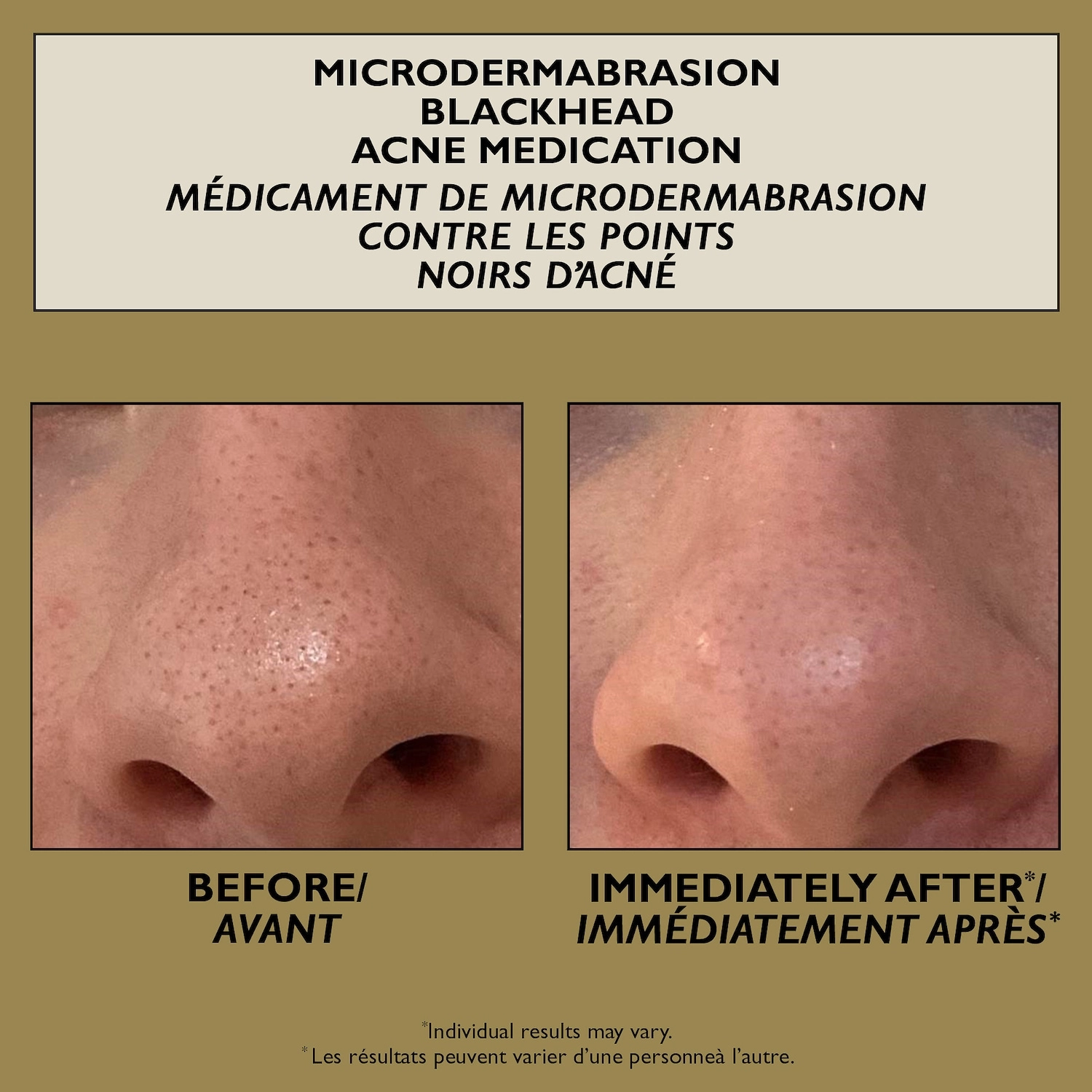 Peter Thomas Roth Microdermabrasion Blackhead Acne Medication 2 oz/57 mL Hyaluronic Acid - Image 2