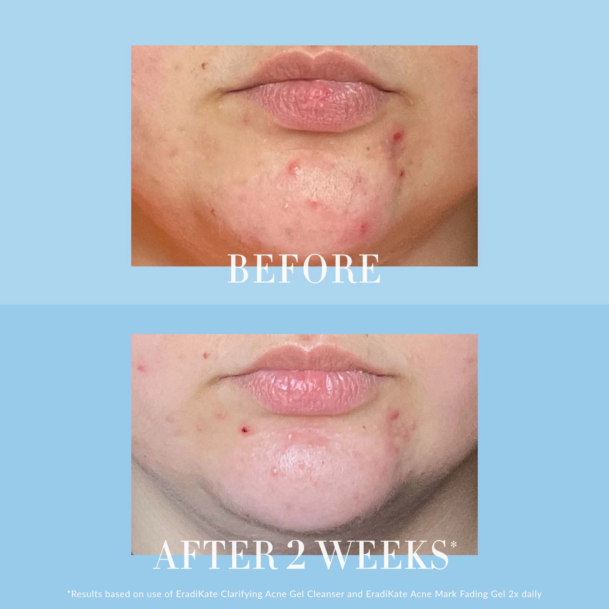 Kate Somerville EradiKate™ Clarifying Blemish Gel Cleanser with Salicylic Acid, Prebiotic Complex & Niacinamide 4 oz/120 mL - Image 4