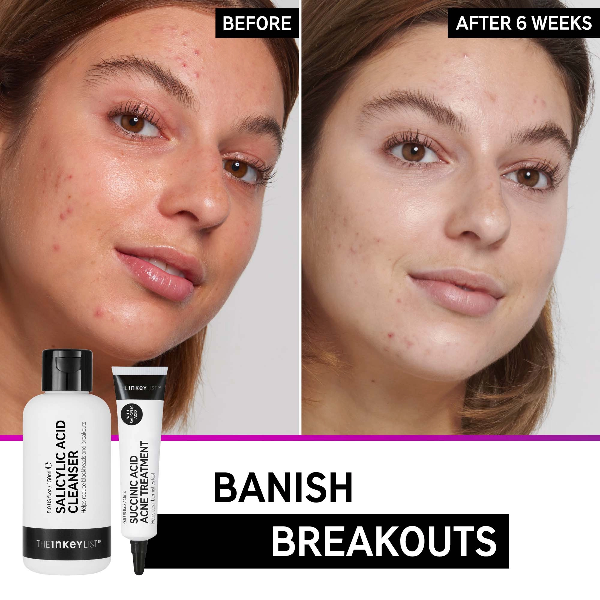 INKEY List Back to Basics: Goodbye Acne Skincare Set - Image 2