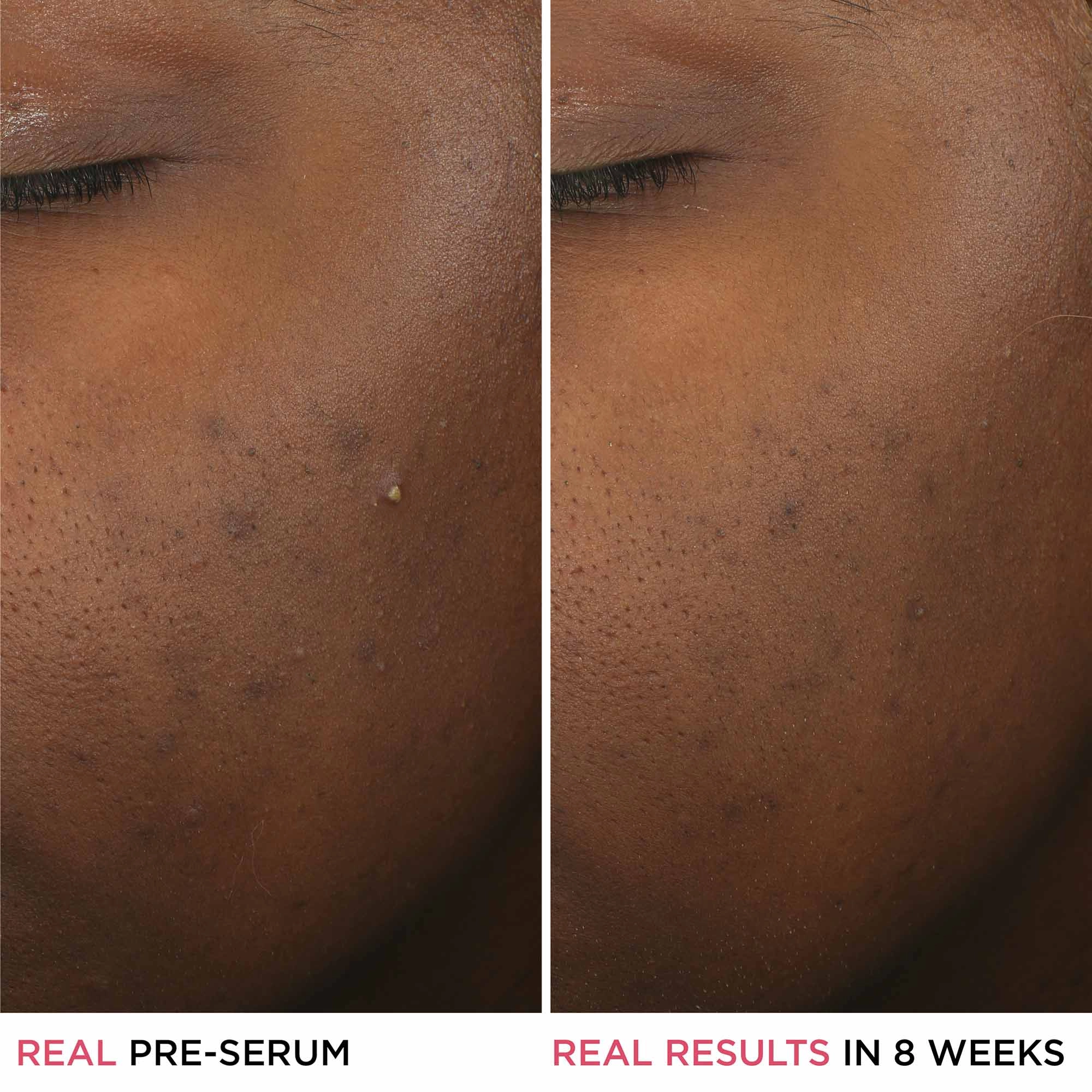 IT Cosmetics Bye Bye Breakout 2% Salicylic Acid Acne Treatment - Lactic Acid, Fragrance Free - Image 3