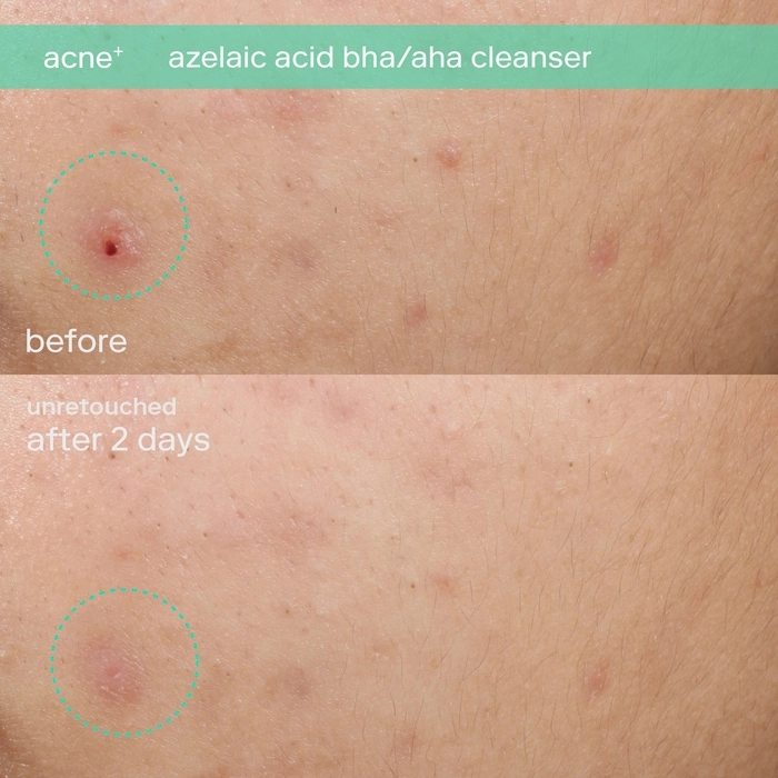 Skinfix Azelaic Acid BHA/AHA Cleanser 1 fl oz / 30 mL - Image 3