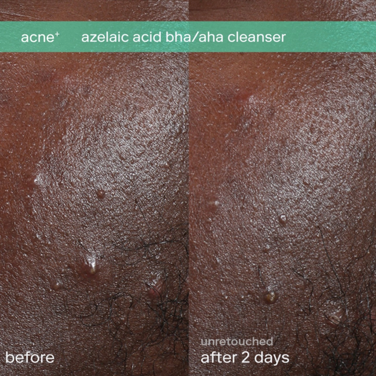 Skinfix Azelaic Acid BHA/AHA Cleanser 1 fl oz / 30 mL - Image 2