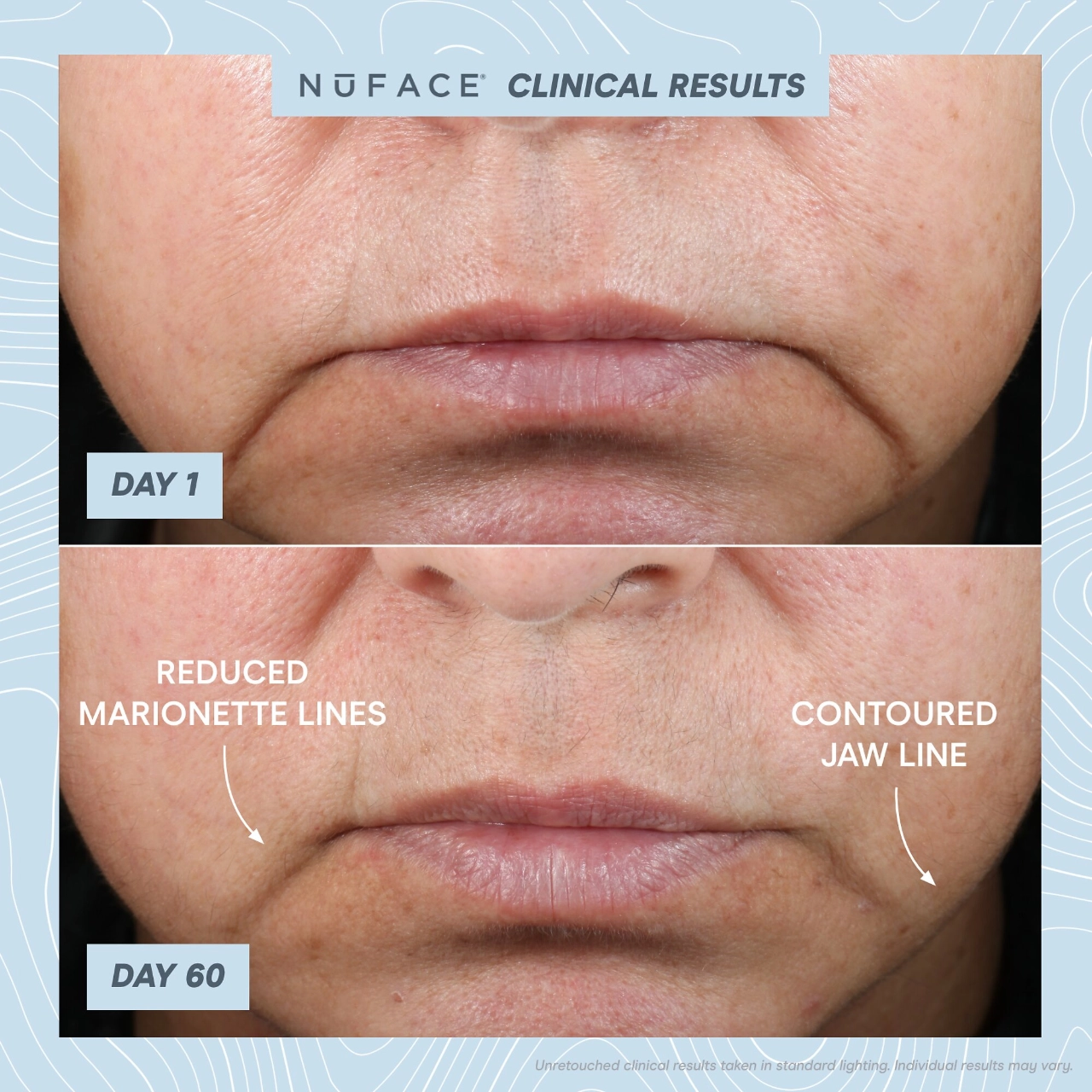 NuFACE Trinity+® Starter Kit - Hyaluronic Acid, Anti-Aging, Oil-Free - Image 4